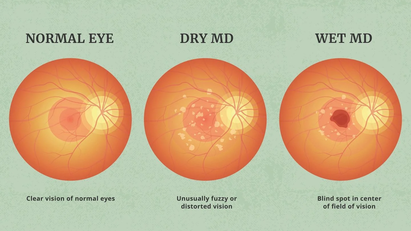 amd disease treatment