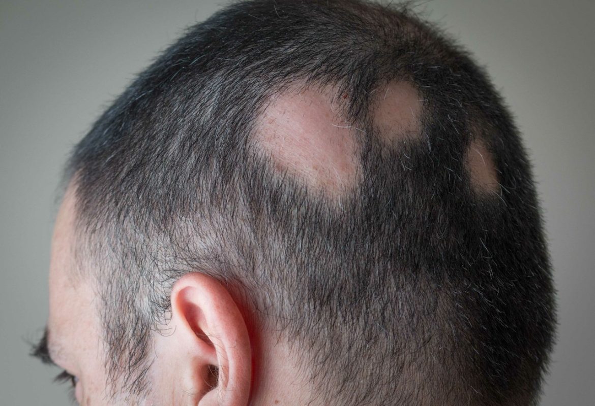 Hair Restoration Simplified with Topical Finasteride